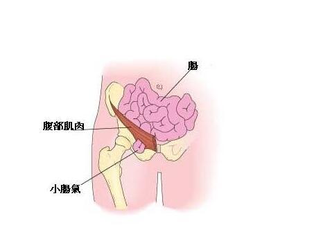 疝气会有什么症状图片