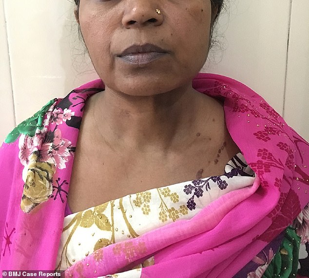 印度婦女切除了近9斤重腫瘤 國際 第1張