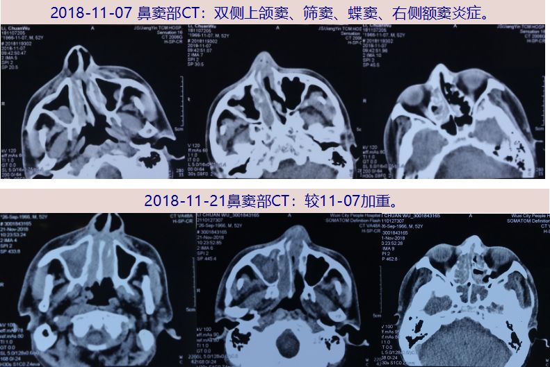 慢性鼻竇炎十餘年,發作時多伴少量膿涕,無明顯鼻塞.