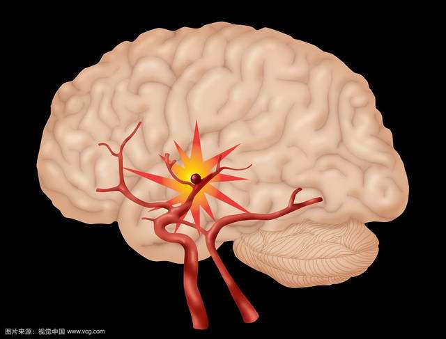脑梗死脑血栓及脑出血的区别