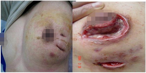 发炎性乳腺癌初期图片图片