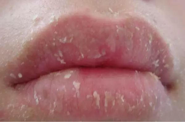 健康嘴唇干裂脱皮不仅是因缺水还可能是患了唇炎