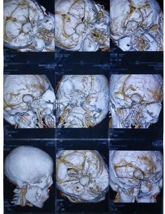 貝朗時間第四十三期丨步星耀教授團隊dolence入路頸內動脈段眼動脈瘤