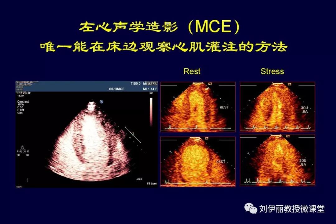 冠心病心肌缺血和超声造影心脏负荷试验