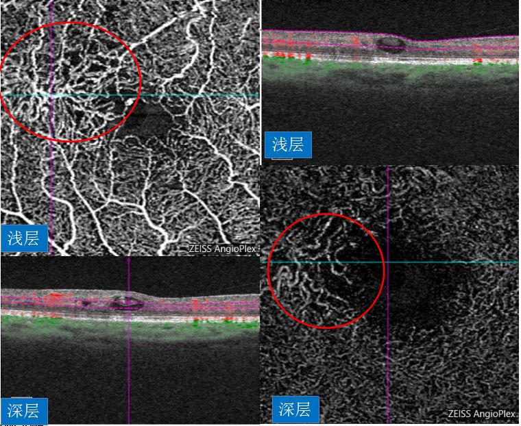 oct血管成像oct断层扫描:右眼黄斑区局部神经上皮层隆起,层间可见大泡