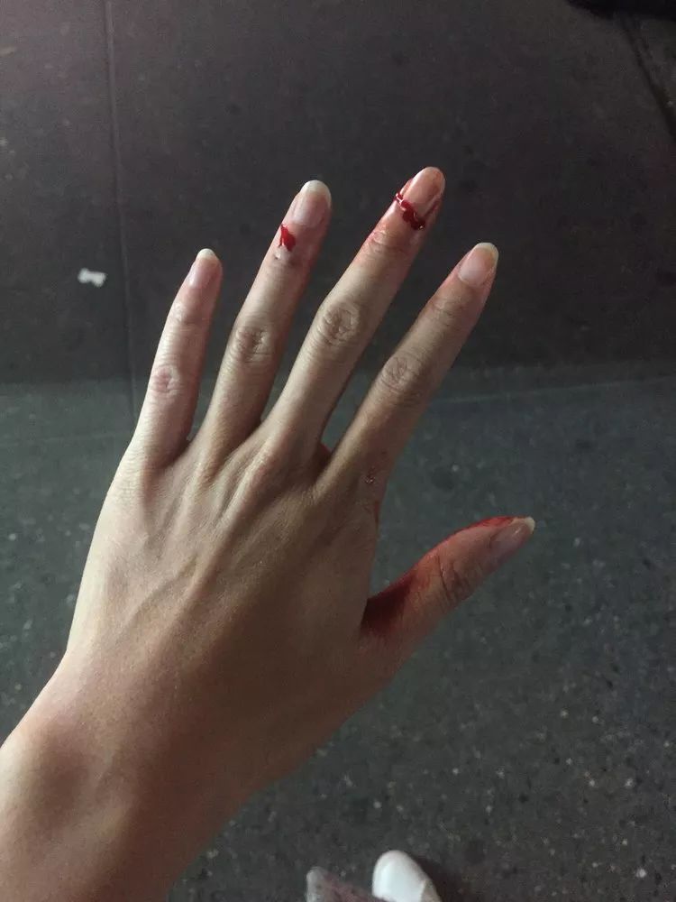 女生受伤的手照片图片
