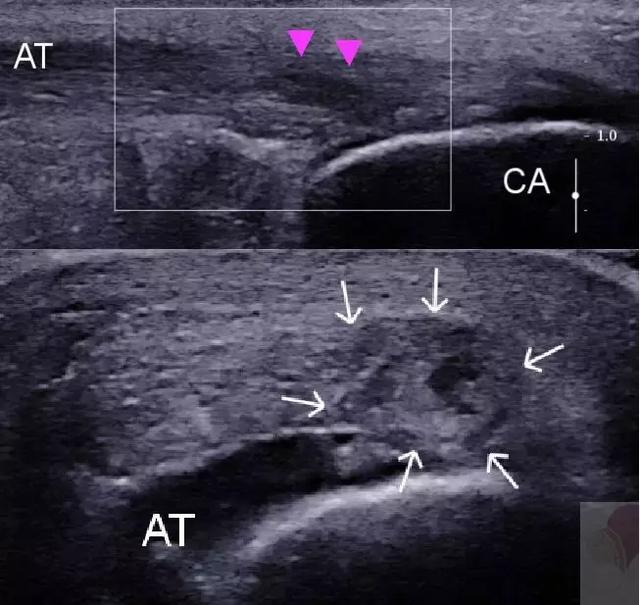 肌腱断裂超声图片图片