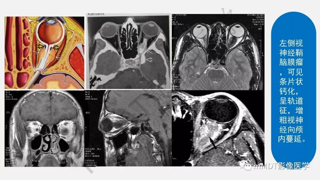 眼眶肌锥内常见肿块ctmr诊断