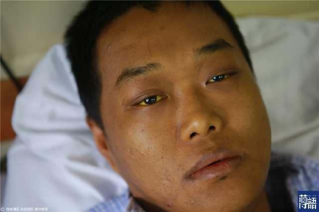 28岁小伙快餐店打工2年查出16种疾病 眼白黄得可怕