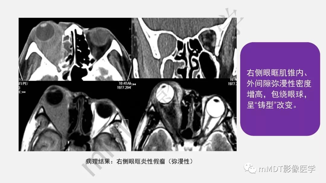 眼眶肌錐內常見腫塊ctmr診斷