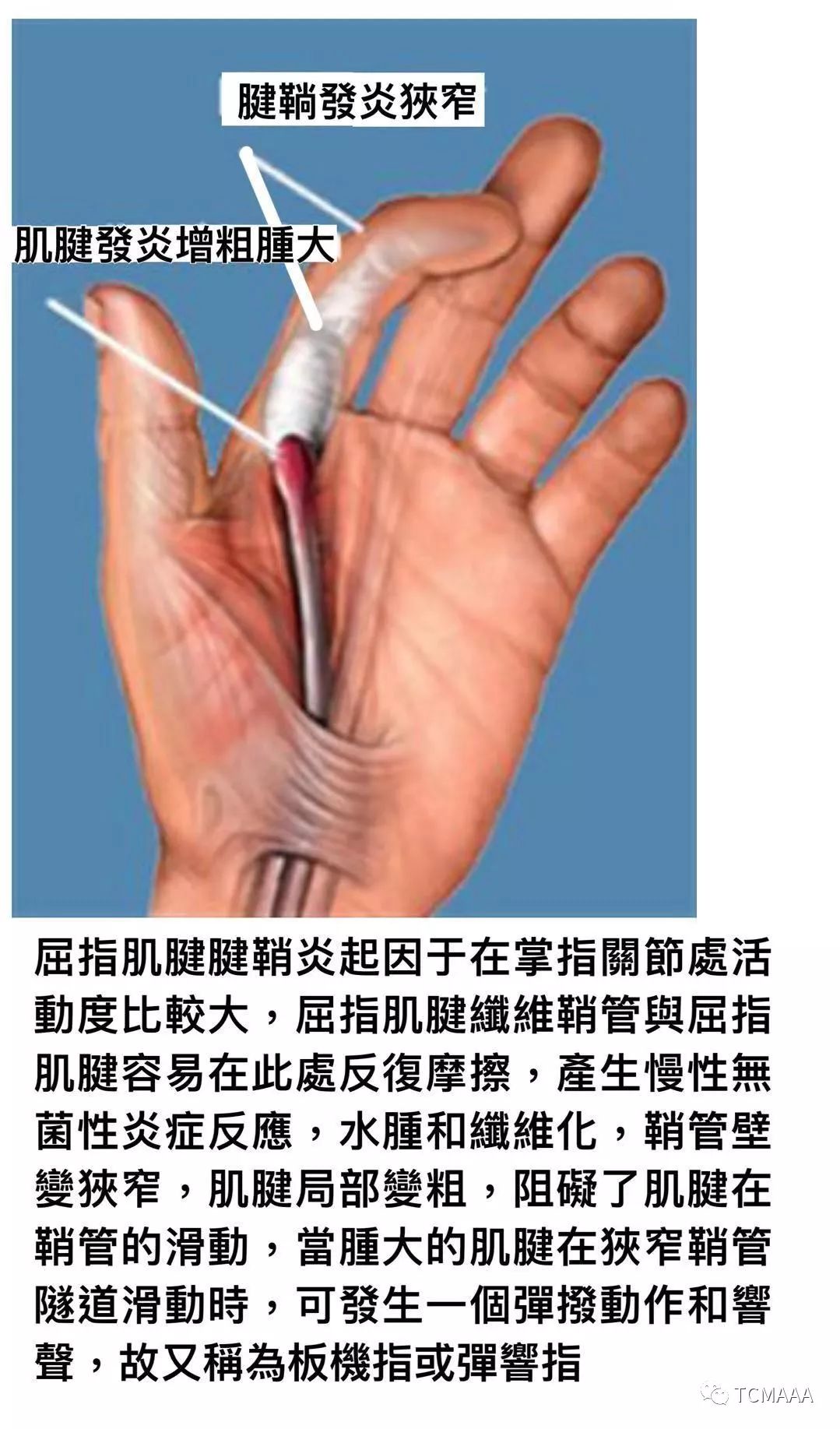 手指屈肌腱鞘炎图片