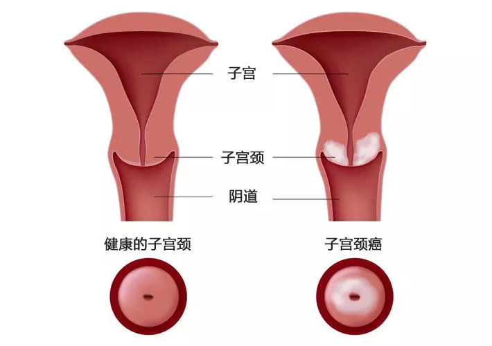 子宫位于盆腔中央,是一个形似倒置的梨形的肌性器官,其前后邻居分别为