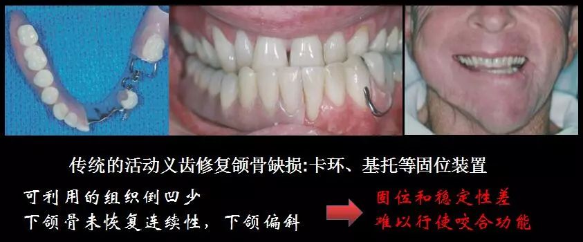 青醫61新技術丨下頜骨腓骨移植聯合牙種植術後的覆蓋義齒修復