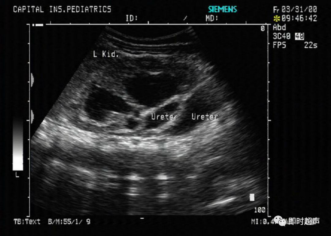 小儿异位输尿管囊肿的超声特征