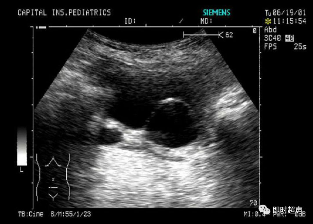 小儿异位输尿管囊肿的超声特征