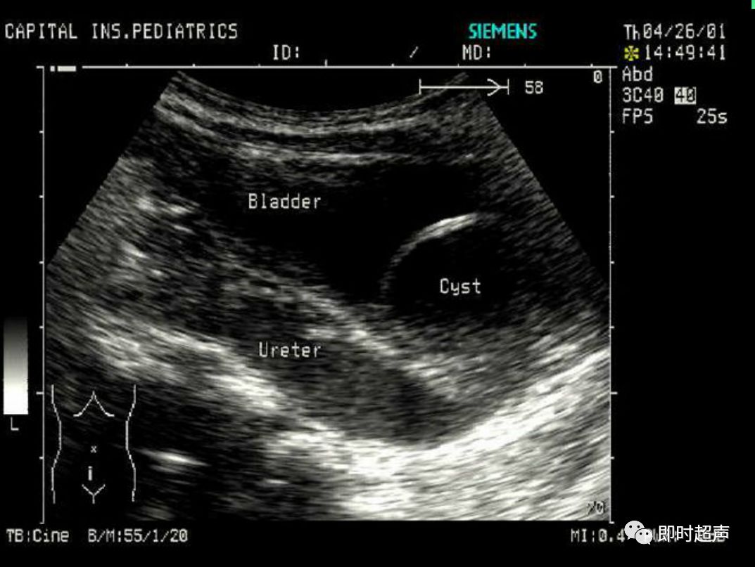 小儿异位输尿管囊肿的超声特征