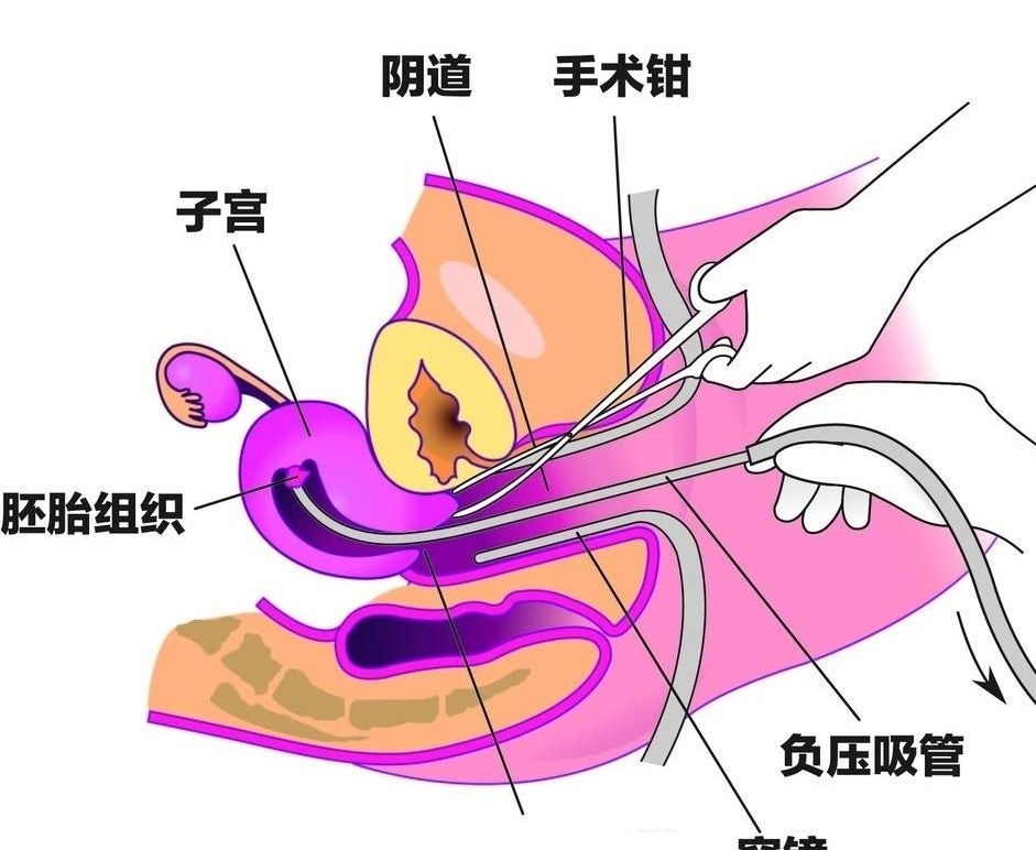 人流后宫颈图片图片