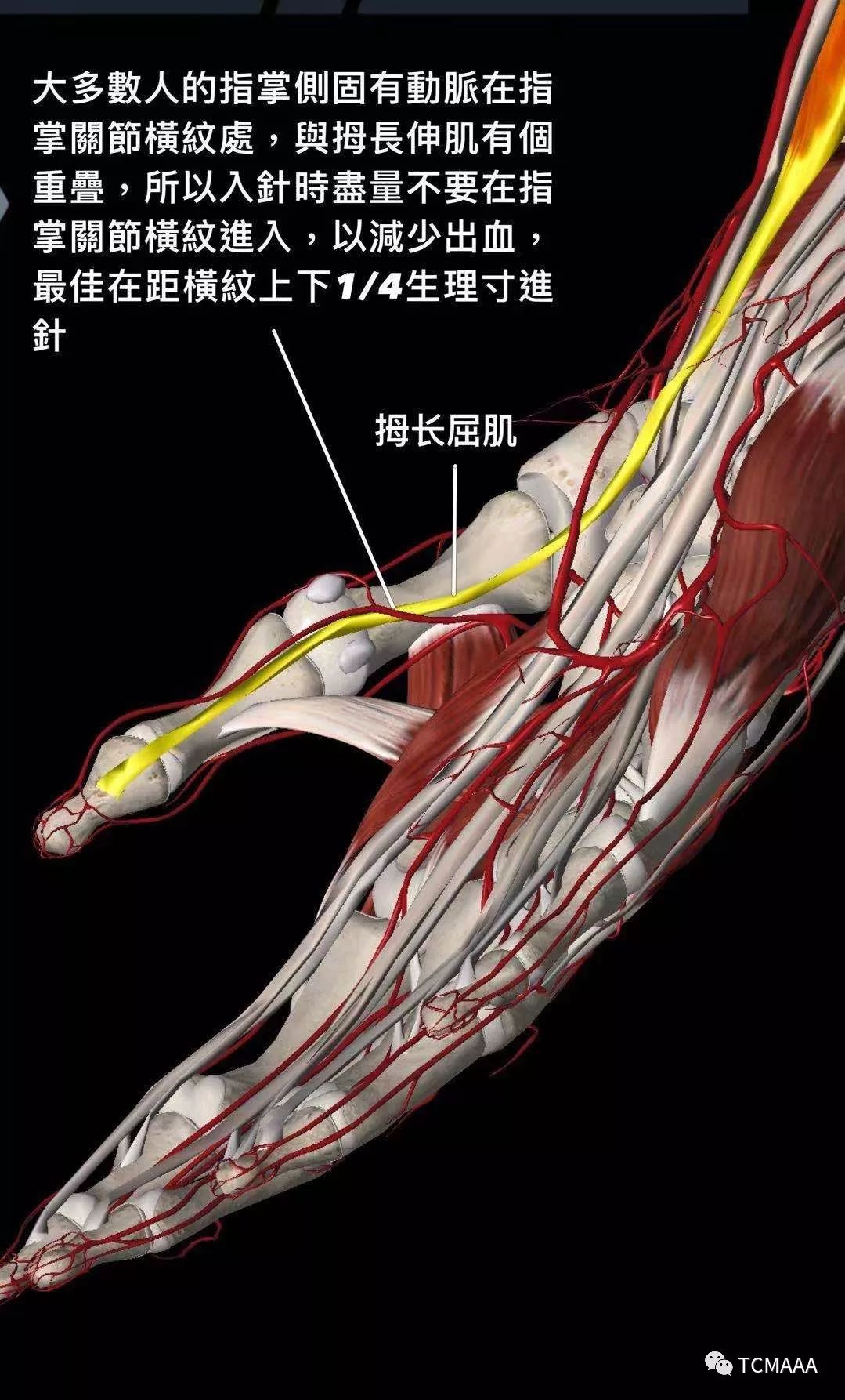 腱鞘炎松解术手术图解图片