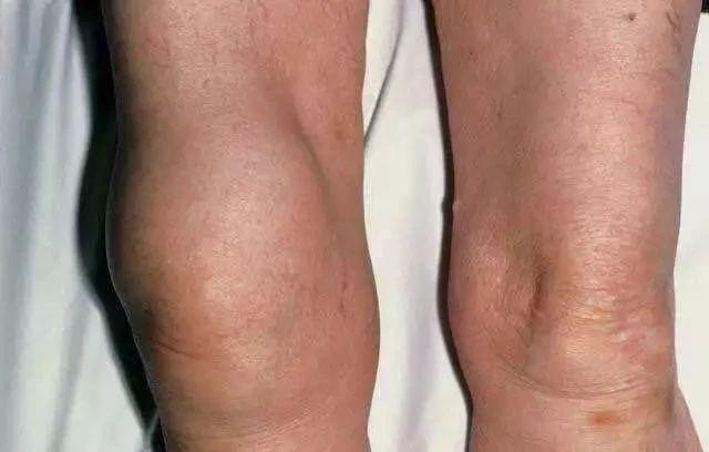 不明原因的膝关节肿胀疼痛需警惕滑膜炎在作祟