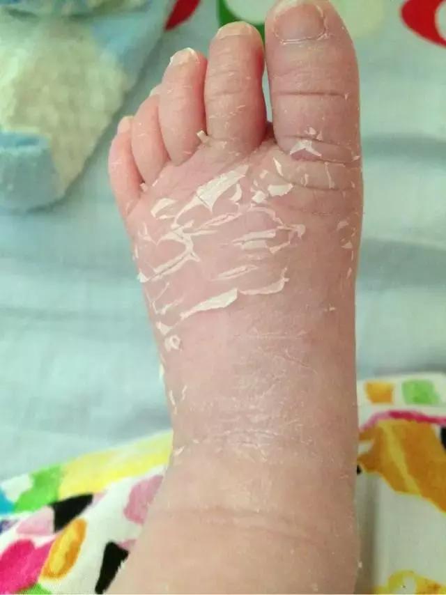 新生儿最易出现的10种皮肤问题,好孕妈妈教你这样护理