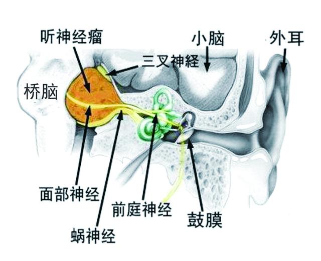 警惕耳朵里的知了声