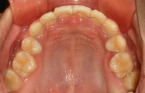 这种保持器无需摘戴,刚拆牙套时,医生会将舌侧丝固定在上下前牙内侧