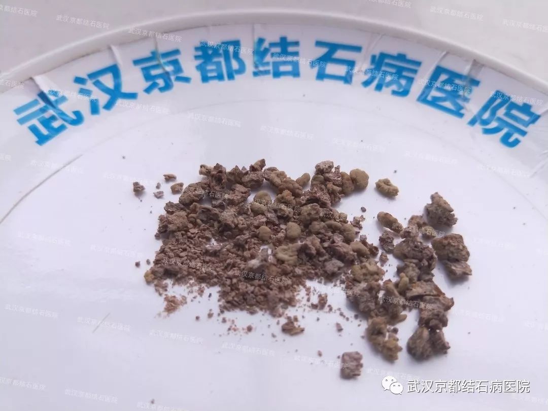 婆婆输尿管结石体外碎石后送命千万别盲目体外碎石