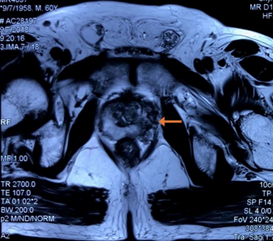 前列腺癌ct表现图片图片