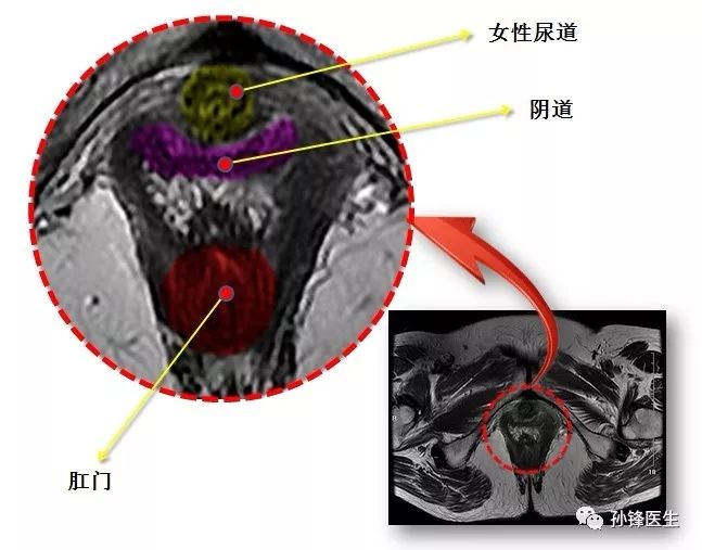 醫學筆記鋒哥教你讀盆腔核磁共振3經女性恥骨聯合下份的橫斷層