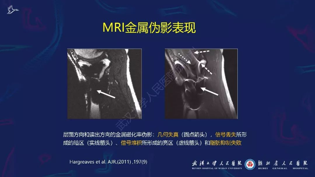 肌骨mr i金属伪影抑制技术临床应用