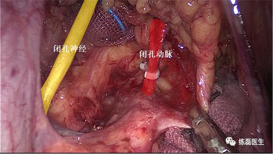 2 裸化臍動脈完畢後,繼續沿髂內動脈向遠端逐步分離,注意辨認膀胱下