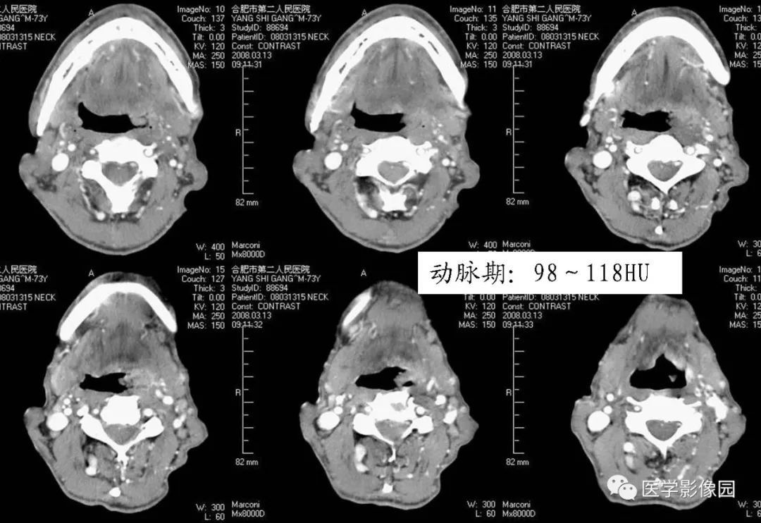 扁桃體惡性腫瘤,等你分析 | 讀片專欄972期