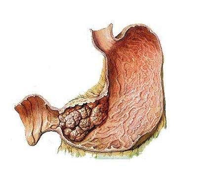 領募:什麼是胃腸道間質瘤?它是癌症嗎?