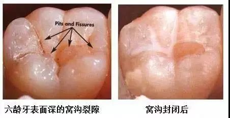 3,如何保护预防大牙龋坏呢? (1)做窝沟封闭