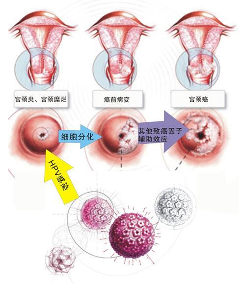 宫颈癌的早期症状图片