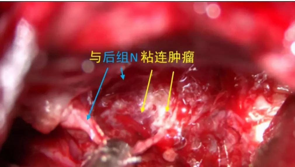 病例分享儿童髓母细胞瘤综合治疗一例