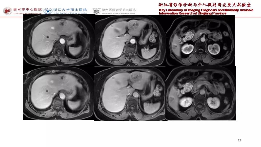 每日一例738例肝臟神經內分泌腫瘤