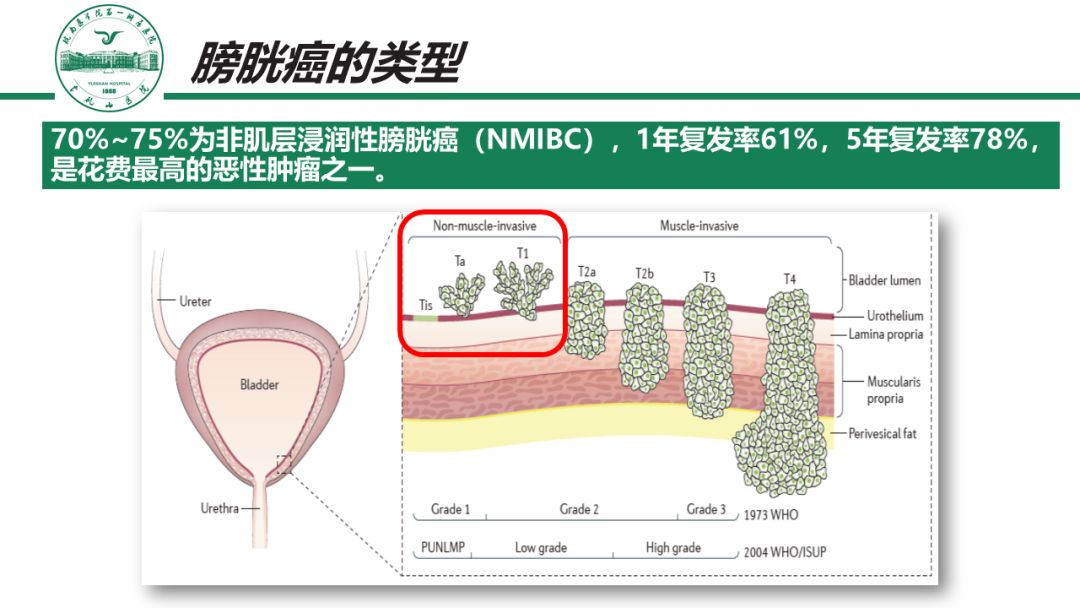 70~75%为非肌层浸润性膀胱癌(non-muscle-invasivebladdercancer