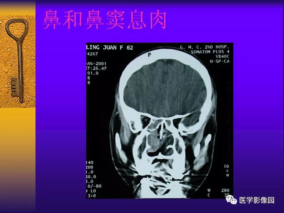 鼻腔及副鼻竇病變影像診斷