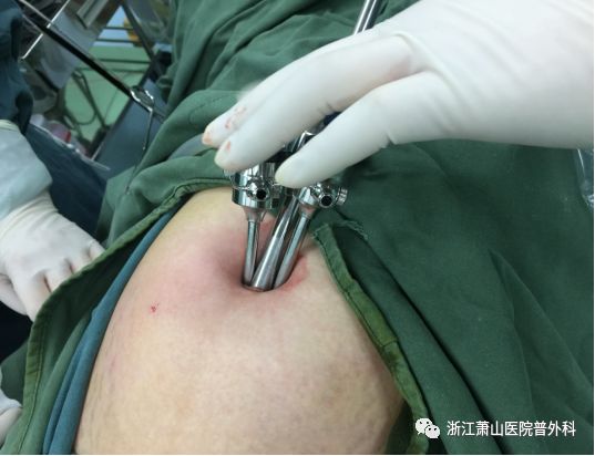 经脐单孔腹腔镜手术让无瘢痕成为现实