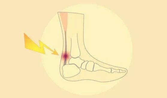 为持续性疼痛;跟腱止点处出现肿胀,皮温增高或触痛;跟骨后滑囊炎患者