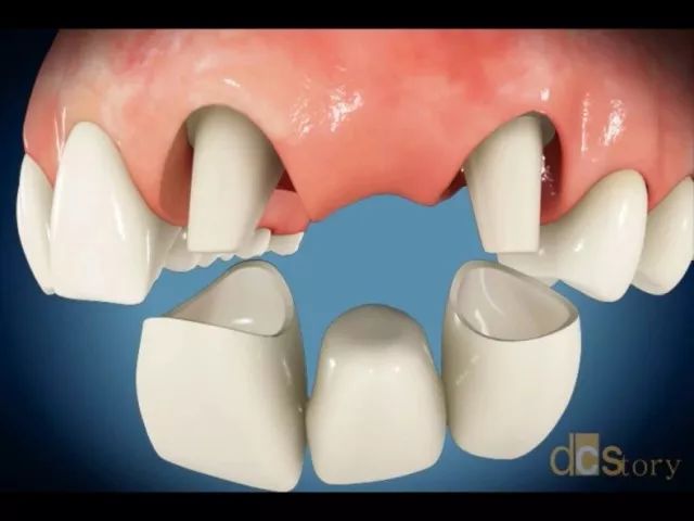 缺一颗牙却要镶三颗牙,这种属于烤瓷固定桥修复,需要旁边的两颗牙做上