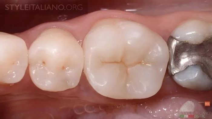 即刻牙本質封閉(immediate dentinal sealing, ids)深緣抬升(deep