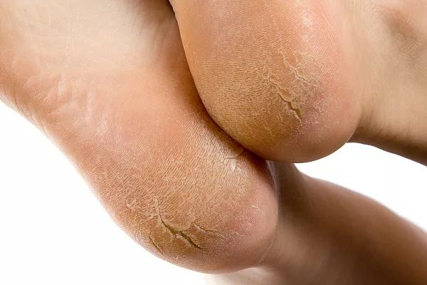手脚干裂缺什么维生素？