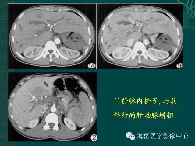 推荐 ctpv-门静脉海绵样变性