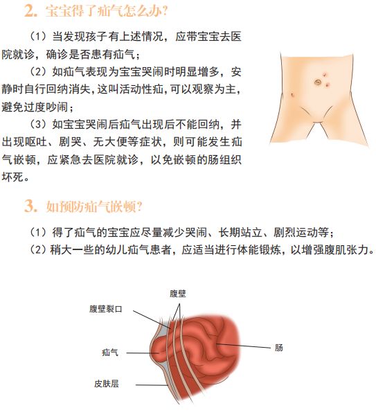 女宝疝气的症状图片