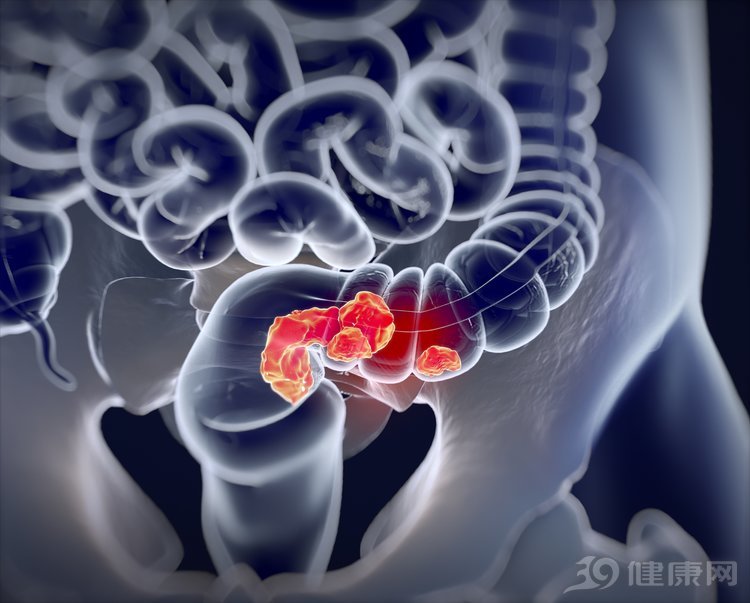 為什麼越來越多年輕人得大腸癌？3件事你沒早做 健康 第3張