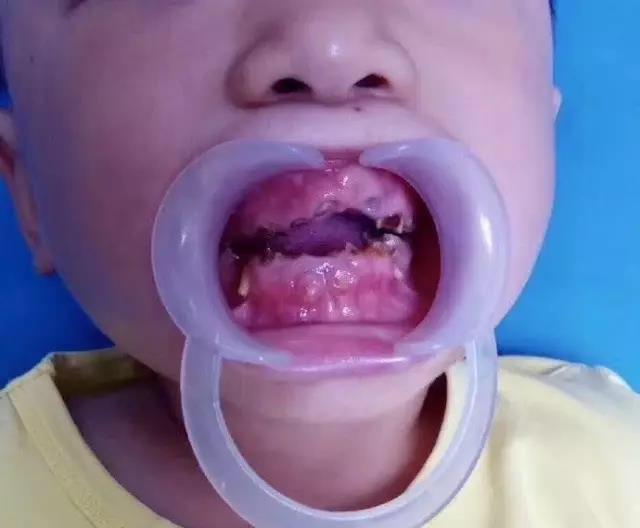 儿童蛀牙图片严重图片