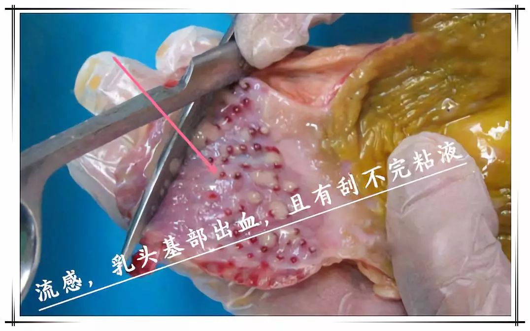 腺肌胃臨床