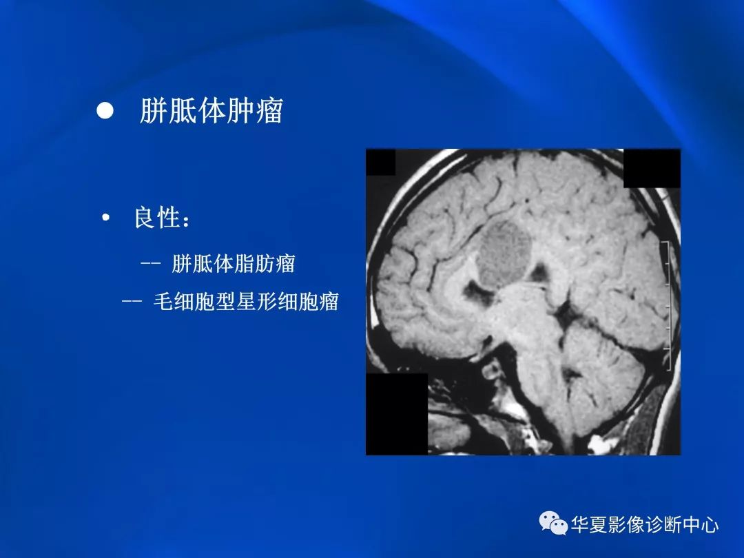 胼胝体病变影像学表现二